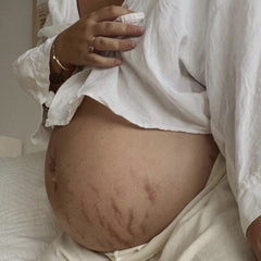 The Pregnancy Stretch Mark Duo